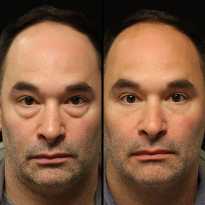 MillowSupply™ Reparador de ojeras