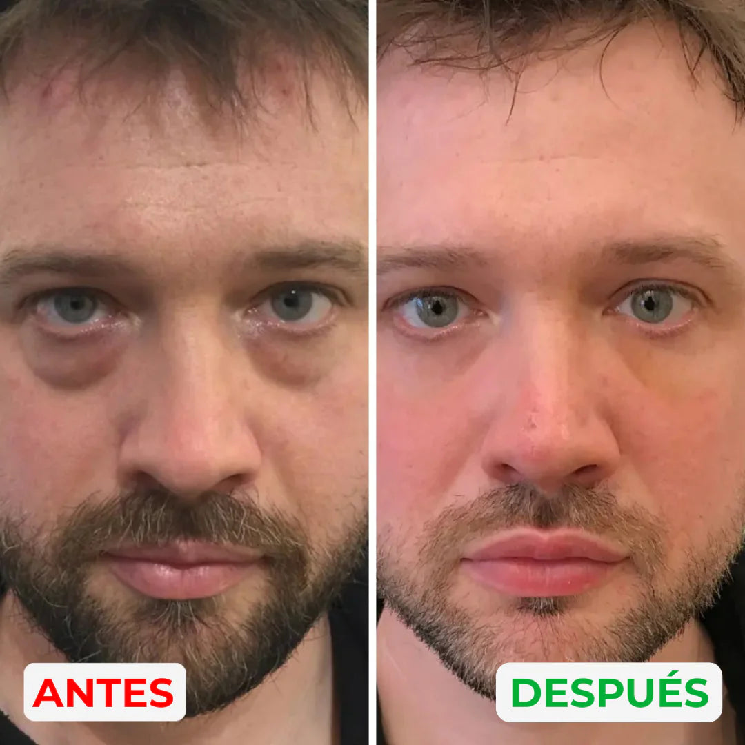 MillowSupply™ Reparador de ojeras