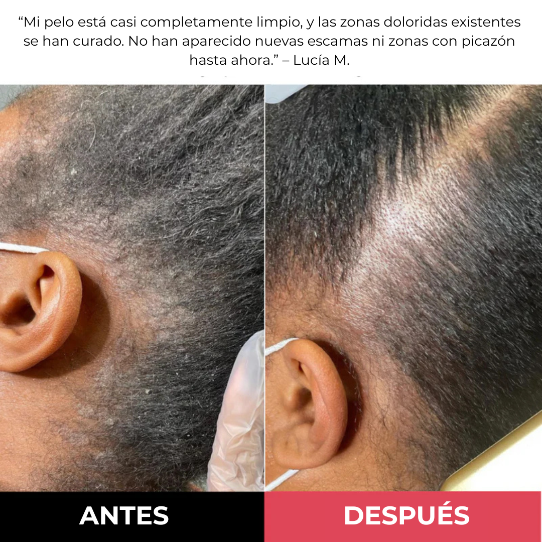 Exfoliante para el cuero cabelludo MillowSupply™