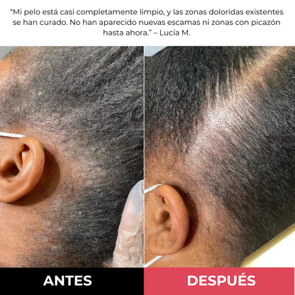 Exfoliante para el cuero cabelludo MillowSupply™