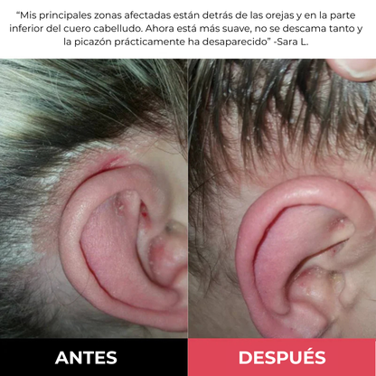 Exfoliante para el cuero cabelludo MillowSupply™